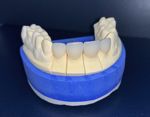Licówki przygotowane do przyklejenia na zębach pacjenta